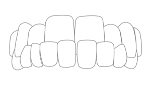 Mesial bite - correction with aligners