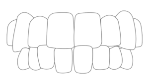 Mesial bite and crossbite correction with aligners